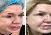 تزریق بوتاکس معجزه کرد+ تصاویر