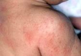 هشدار درباره برجستگی های قرمز ناشی از نیش پشه