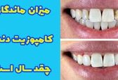 ماندگاری کامپوزیت دندان چقدر و چند سال است؟
