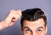 علل مختلف ریزش مو در آقایان