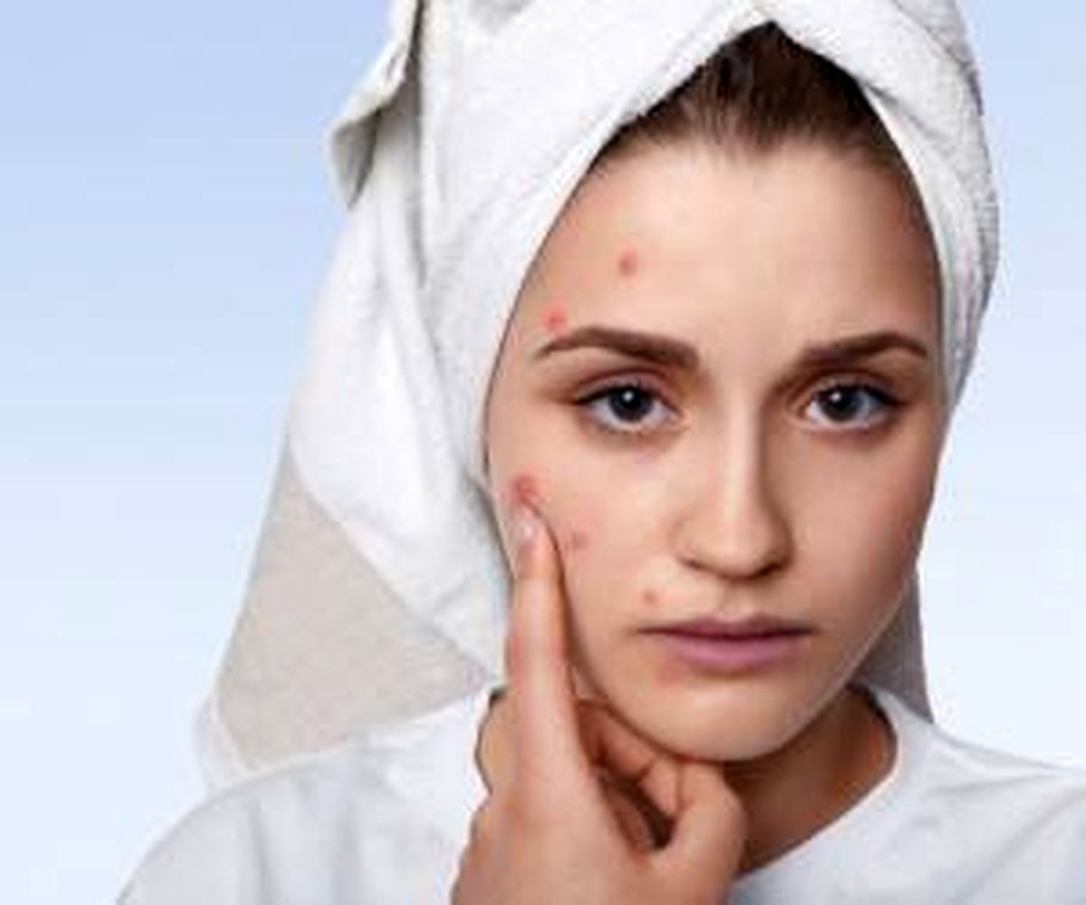 چه کار کنیم در تابستان جوش نزنیم ؟