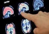 به تایید رسیدن داروی آلزایمر پس از ۲۰سال