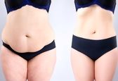 عمل جراحی ابدومینوپلاستی چیست؟ + معرفی پزشک متخصص