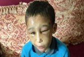 شکنجه های دردآور پسربچه هشت ساله همه ا شوکه کرد+عکس