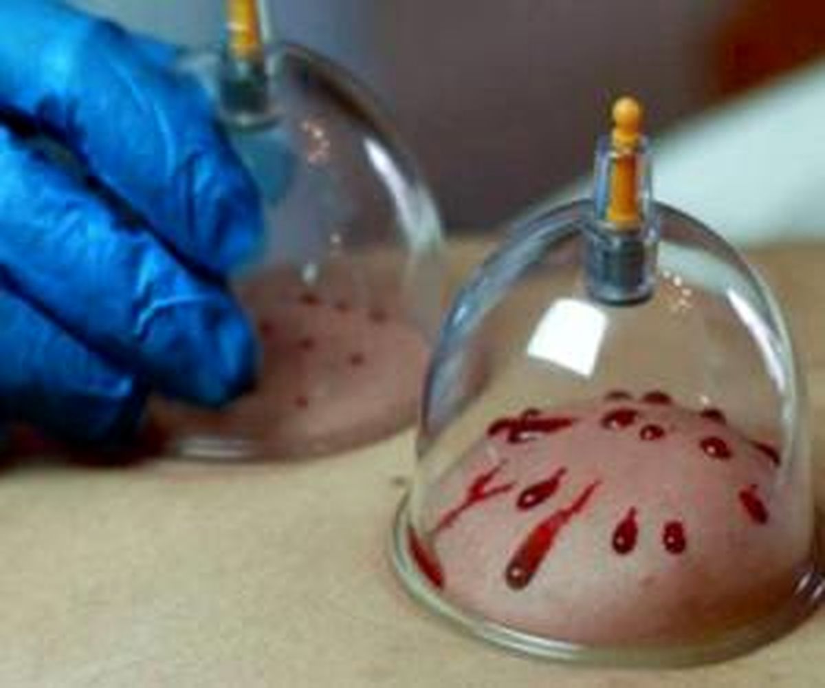 حجامت در بهار برای این افراد ضرر دارد