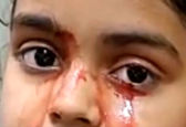 دختری که به جای اشک خون گریه می‌کند +عکس 