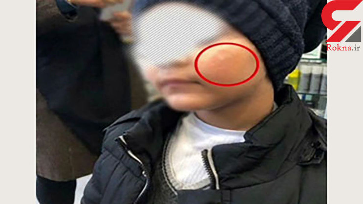 سوزاندن صورت یک پسر بچه با کفگیر در مهد کودک؟+عکس 