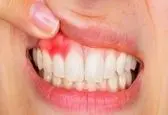 چگونه باید عفونت دندان را درمان کنم؟