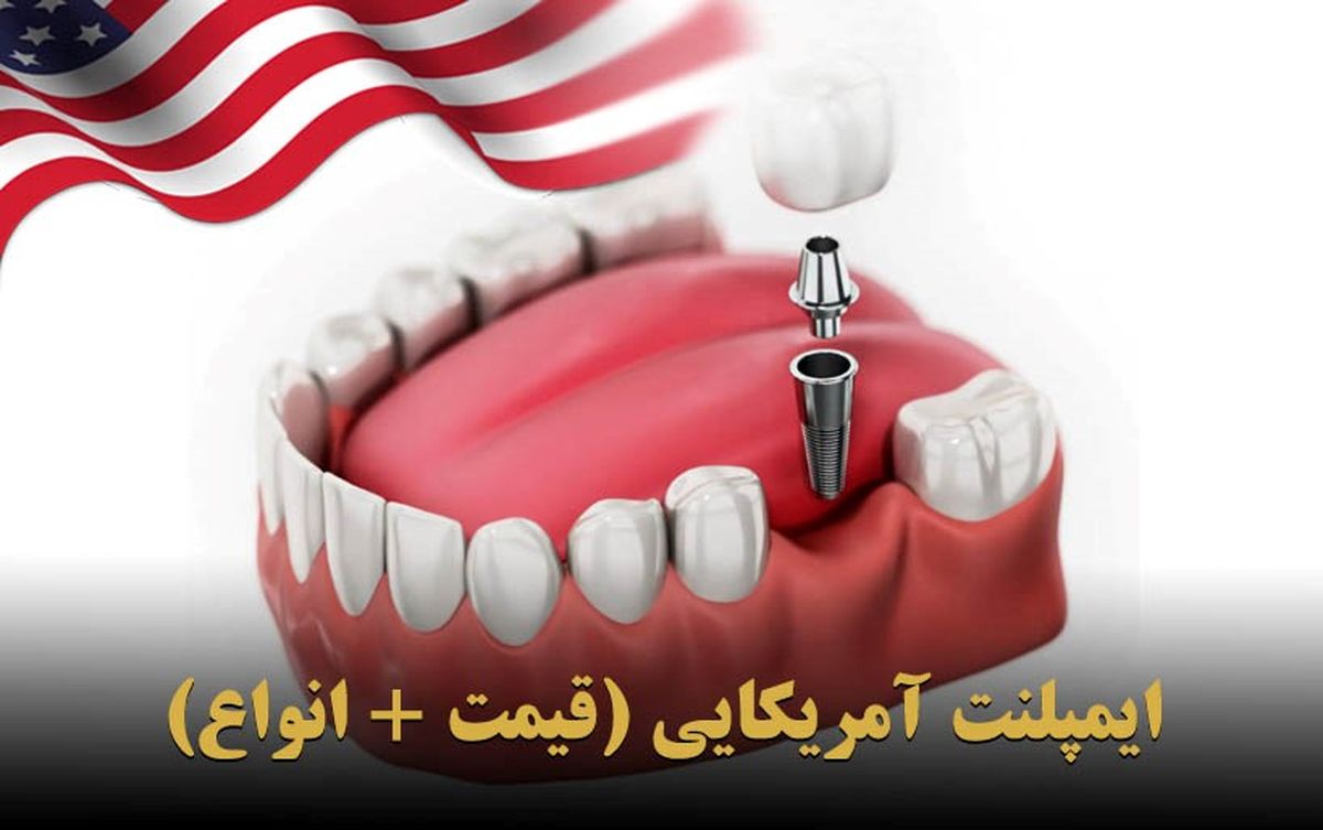 ایمپلنت دندان در آمریکا (مقایسه قیمت به دلار و تومان)