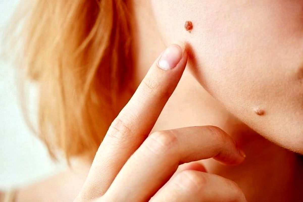 راه حل ساده برای از بین بردن خال های بدن