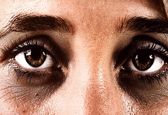 سیاهی دور چشم که نشان از بیماری خطرناک دارد