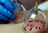 این افراد نباید در فصل بهار حجامت کنند