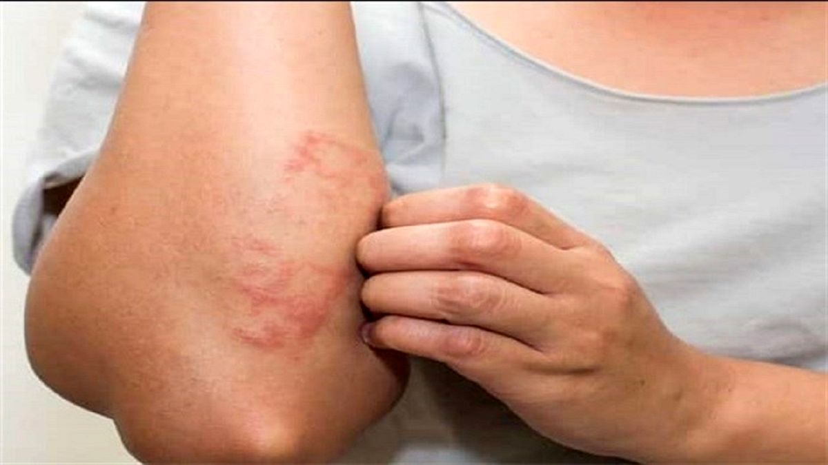 خارش و آلرژی شدید دارید این ۹ ماده غذایی را نخورید