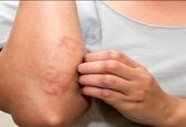 خارش و آلرژی شدید دارید این ۹ ماده غذایی را نخورید