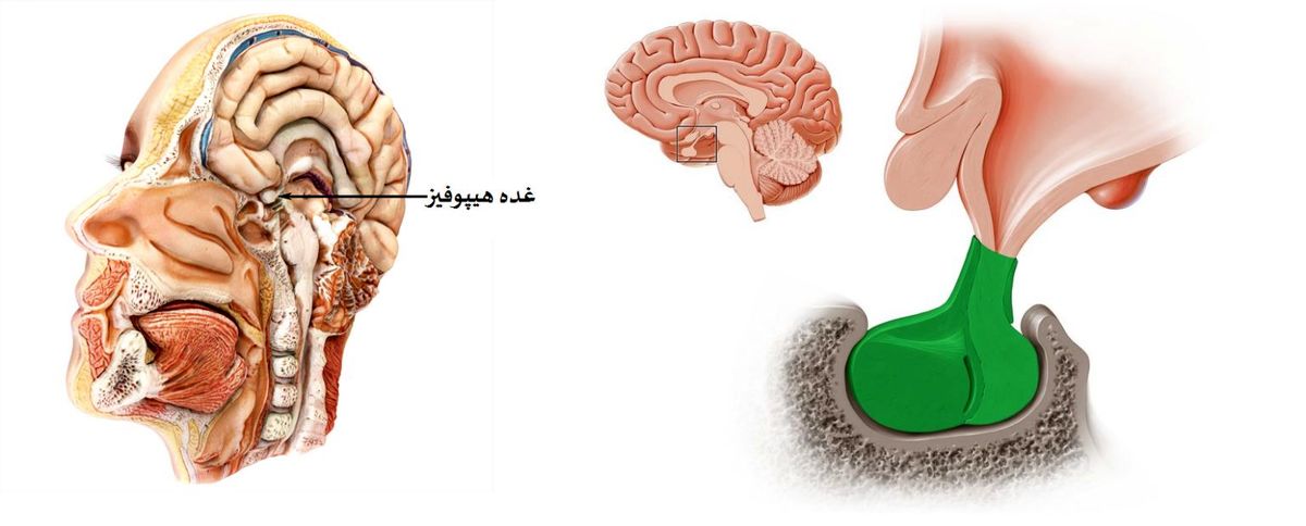 روش‌های درمان تومور هیپوفیز
