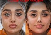 کانتورینگ صورت چیست؟ (کانتورینگ با فیلر و ژل)