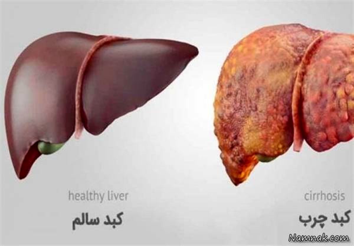 خارشی که نشانه بیماری کبدی است