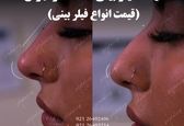 هزینه فیلر بینی 1402 در تهران