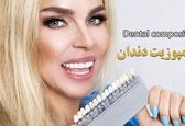 کامپوزیت دندان (مزایا + عوارض + قیمت 1402)