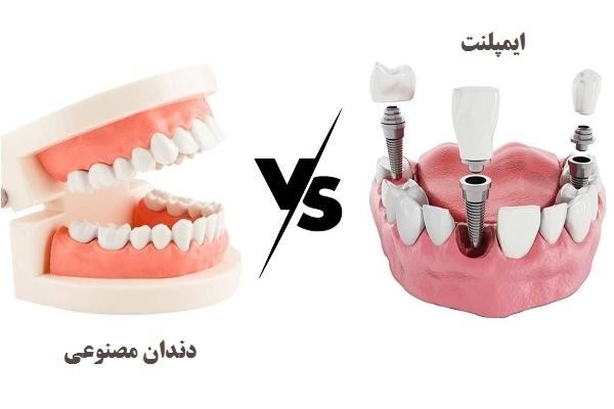 دندان مصنوعی یا ایمپلنت دندان؟