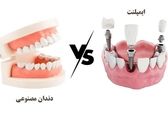 دندان مصنوعی یا ایمپلنت دندان؟