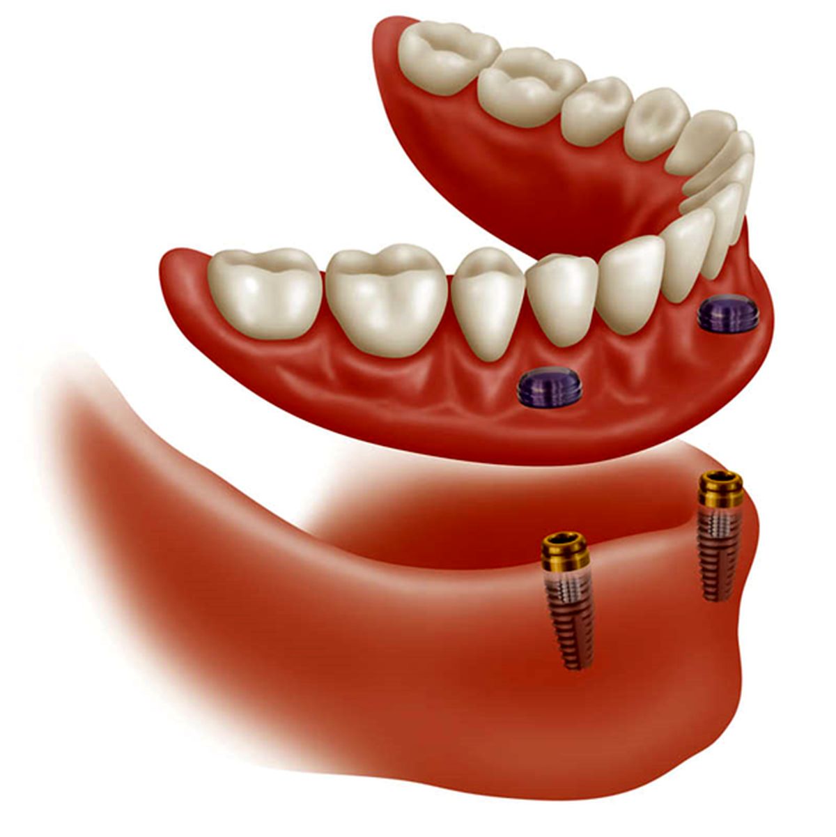 ایمپلنت دندان و لمینت دندان چه تفاوتی دارند؟