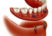 ایمپلنت دندان و لمینت دندان چه تفاوتی دارند؟