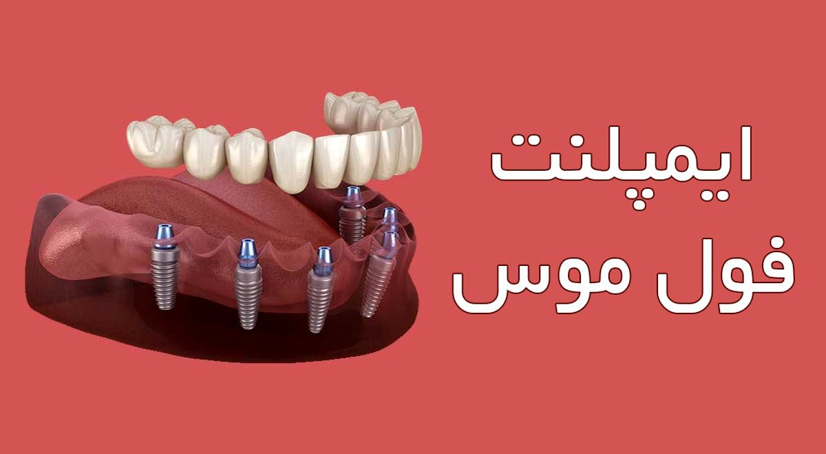 ایمپلنت فول موس ( مزایا ، معایب و مراقبت ها )