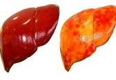 نسخه طب سنتی برای درمان کبد چرب +فیلم