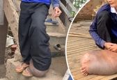 نیش پشه آرزوی پسر کامبوجی را به باد داد! +عکس